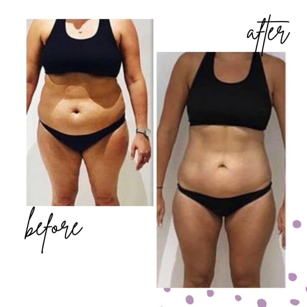 Reducción de volumen abdominal con tecnología Alpha Spa