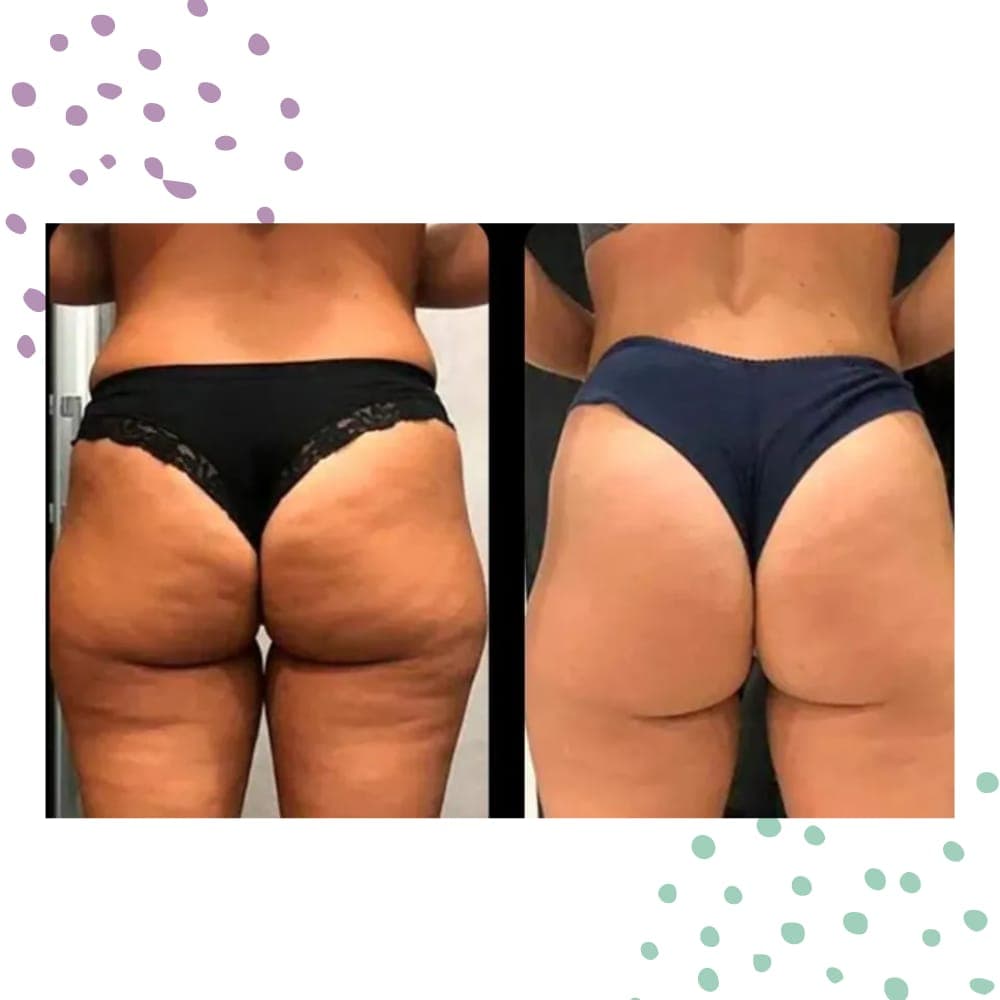 Eliminación de celulitis y remodelación corporal