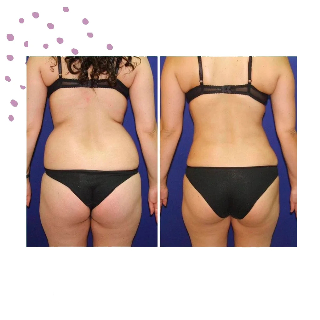 Remodelación corporal